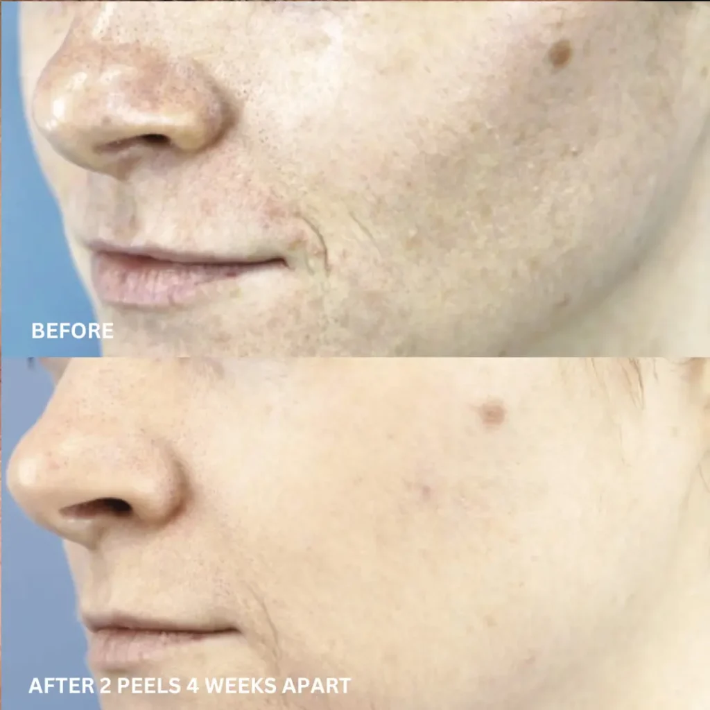 Prodigy Chemical Peel